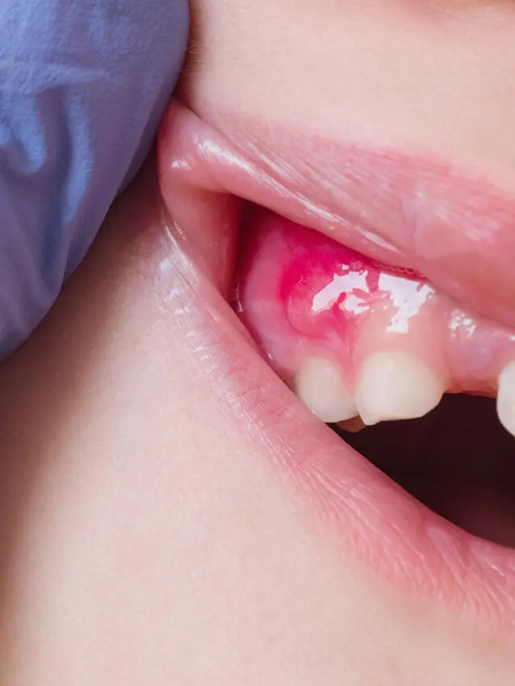Enfermedades dentales: ¿Qué es el flemón y cuánto tiempo dura?